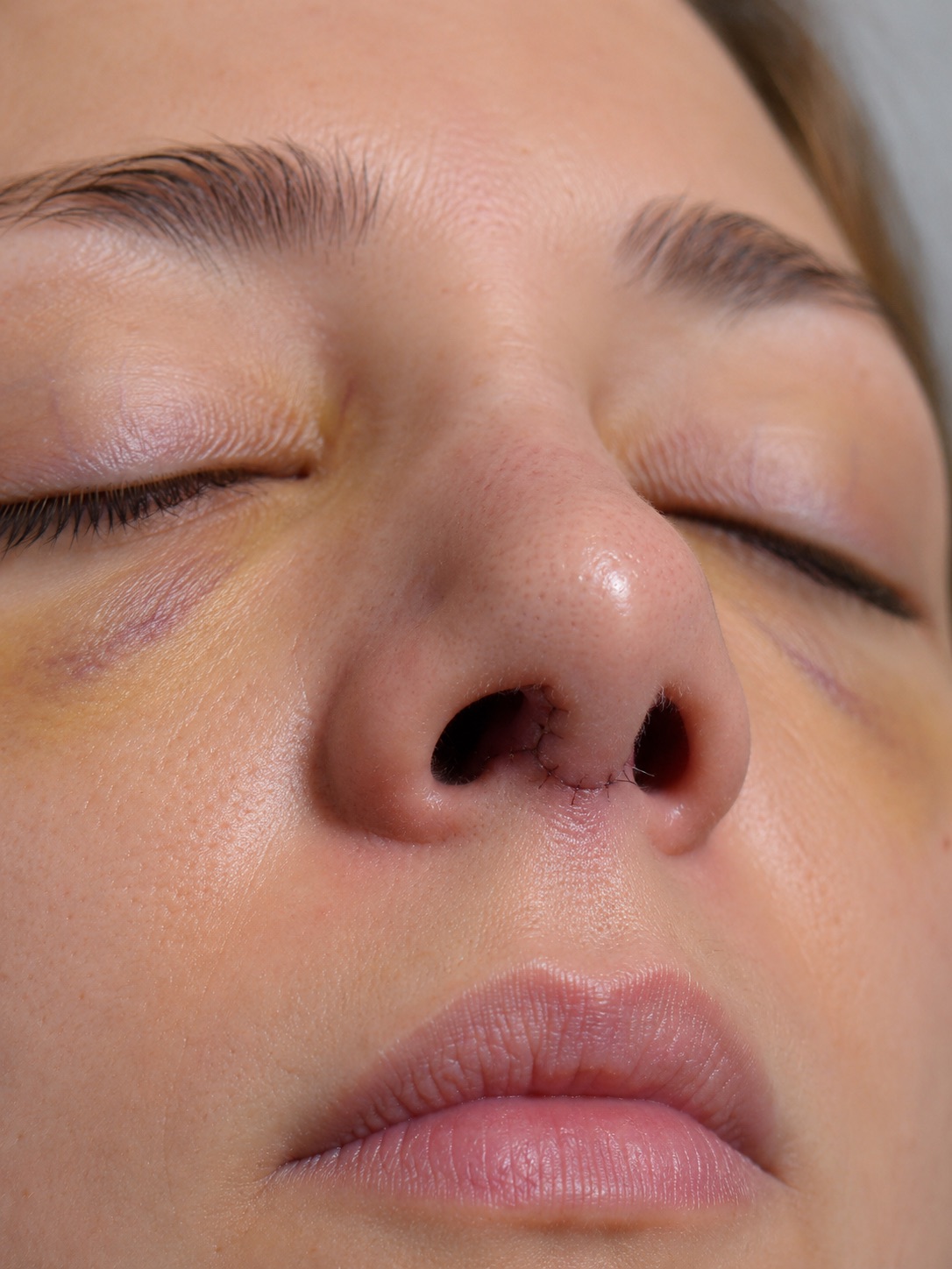 Patient-submitted rhinoplasty healing photo from a structured check-in